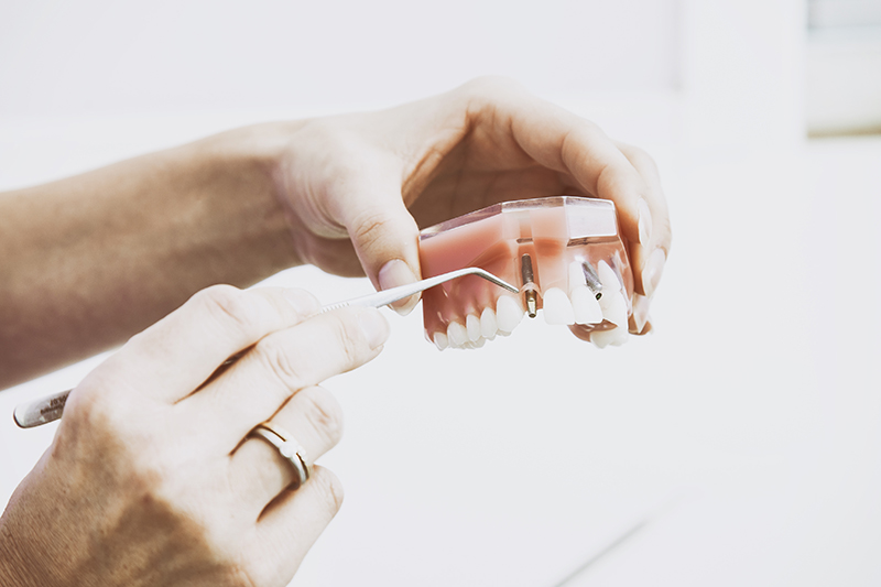 Dentist showing a sample of a dental implant
