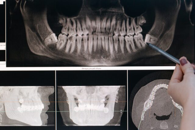 Person pointing to a part of a dental x-ray