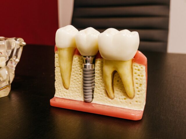 Dental Crown of high quality made by professionals