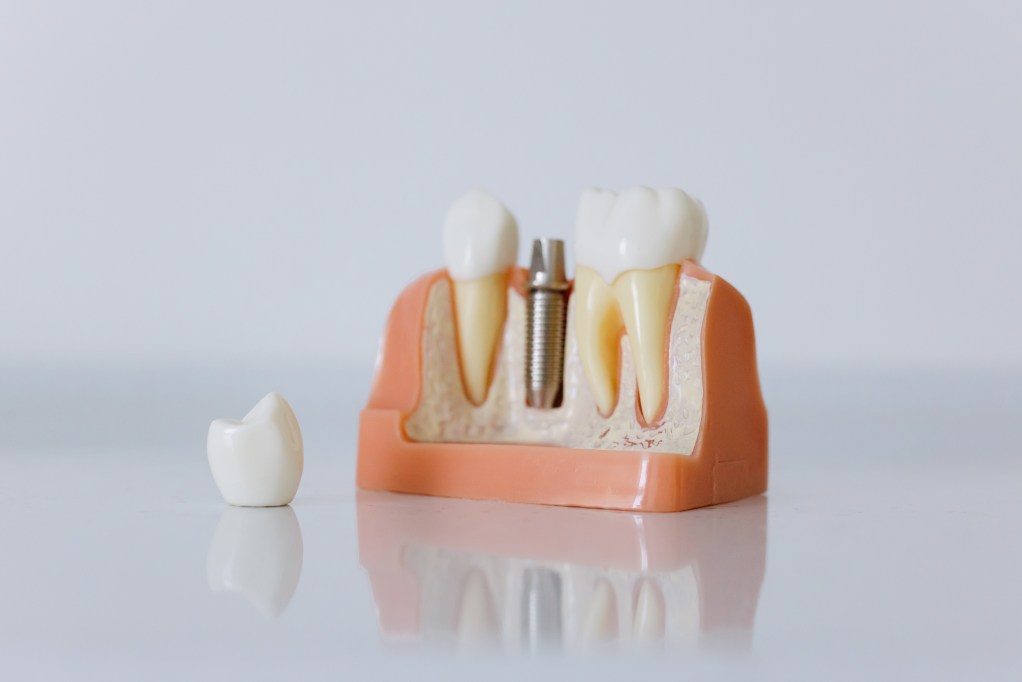 Demonstration of a dental crown for implant
