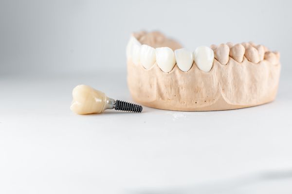 Implantes dentales los Algodones;modelo de maxilar para poner implante dental