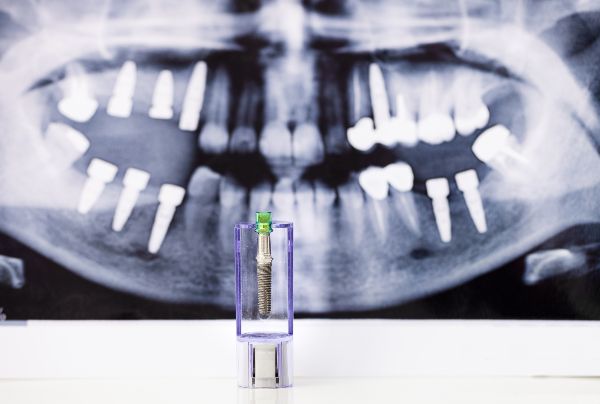 Implantes dentales los Algodones;radiografía de dientes para elegir implante dental